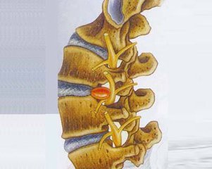 王九正遠紅外理療貼 腰椎間盤突出要抓住改善的黃金時間_1