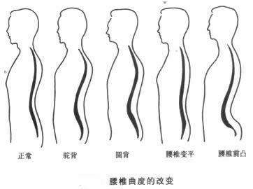 王九正整理腰椎間盤突出有哪些自我檢查方法_1