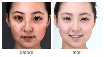 美容院用什么儀器祛斑最好（圖）_1