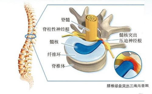 腰椎間盤突出選這個改善一步到位管用徹底_1