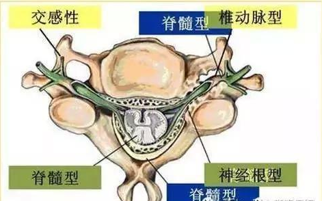 颈椎病分为哪几种？交感神经型颈椎病怎么治？_1