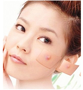 去除痤瘡性疤痕用的什么方法效果好？_1