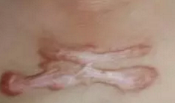 怎么才能祛疤用的方法是什么呢哪種好？_1