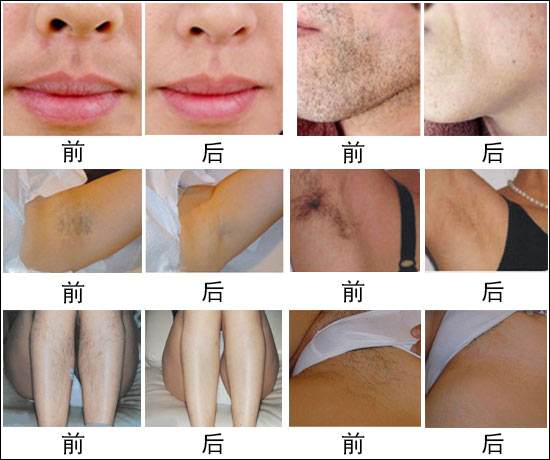 激光脫毛儀排行榜（圖）_1