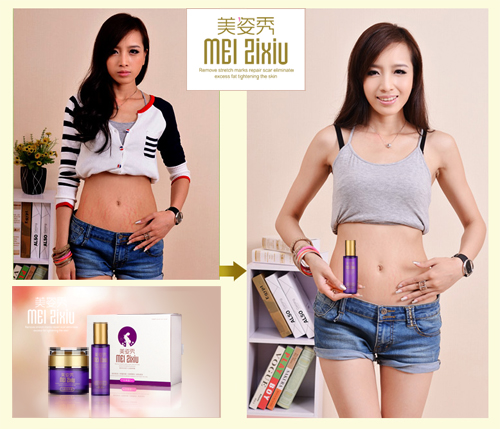 產(chǎn)后用什么去妊娠紋好?簡單方法消滅妊娠紋_1