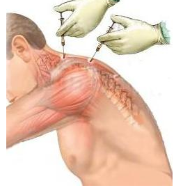 肩周炎是怎么引起的 如何改善肩周炎？_3