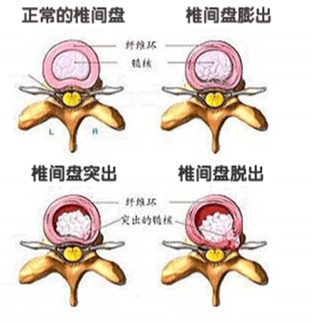 腰椎间盘突出怎么改善，骨科专家教你一招快速治愈（图）_2