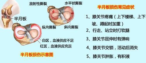 半月板損傷有哪些癥狀表現(xiàn)怎么改善？_2