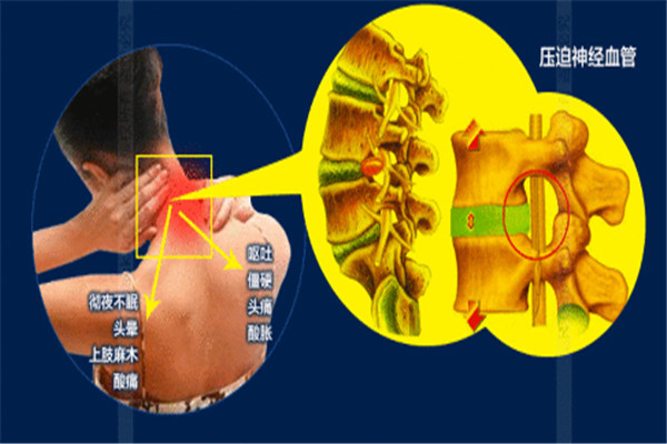 哪種保守療法對(duì)頸椎病最有效？_1