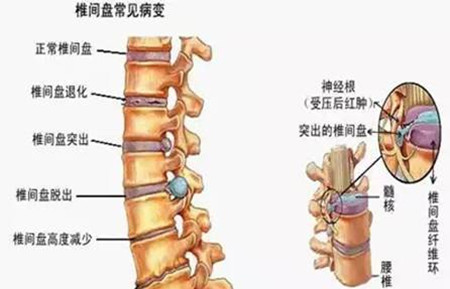 民間妙方改善腰椎間盤(pán)突出效果好花錢(qián)少，不妨試試_3