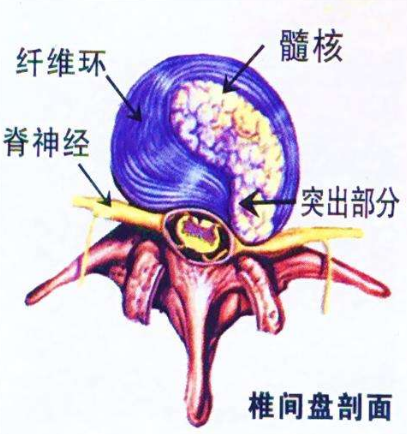 治好腰間盤突出 在家就能解決的問題有嗎？_1