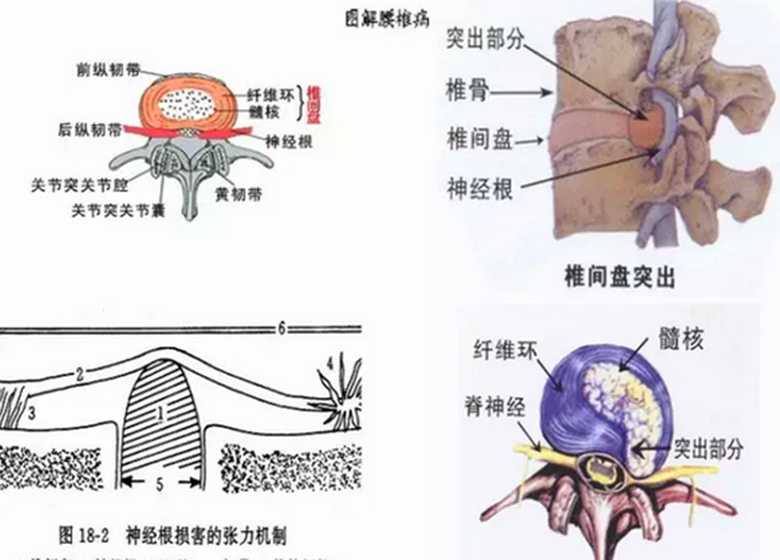 改善腰椎間盤突出的真實(shí)有效方法有哪些？_1