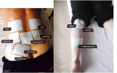 坐骨神經(jīng)痛怎樣改善？喬氏黑玉膏效果好_2