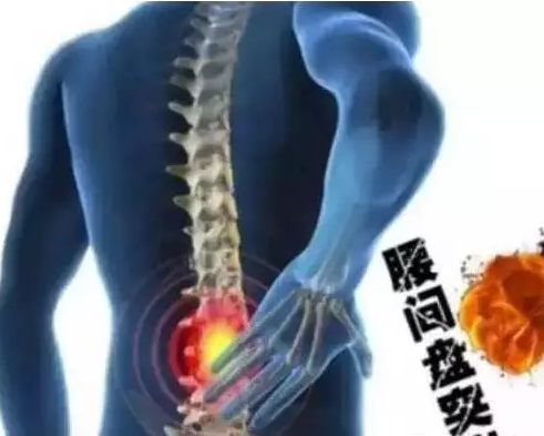 診治腰突的方法改善腰突有什么好方法？_1