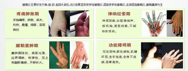 腱鞘炎用什么方法能治好呢？_2