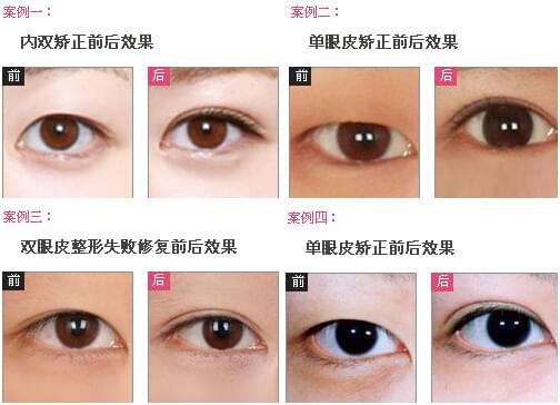 納米無痕雙眼皮培訓(xùn)的兩種方式選哪一種適合你（圖）_1