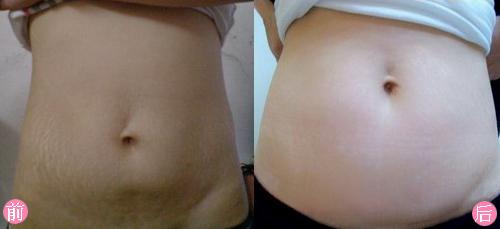 妊娠紋真的可以去掉嗎?徹底消紋在這個夏天美起來_1