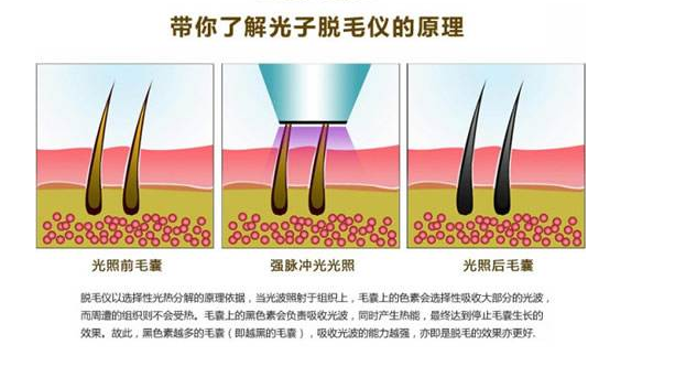 有一次性永久脫毛的方法嗎怎么脫好？_2