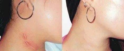 夏天還在擔(dān)心臉上的疤痕嗎_1