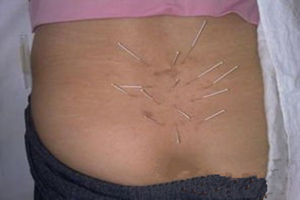 腰間盤(pán)突出怎么治才能好？_1