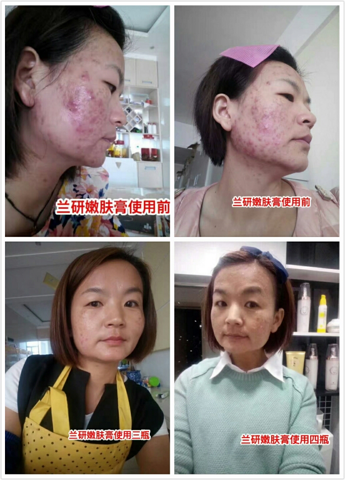 什么產(chǎn)品祛痘最有效?蘭研祛痘膏好用嗎（圖）_2