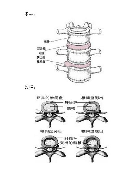 腰椎間盤突出改善能徹底嗎？用什么方法好_2
