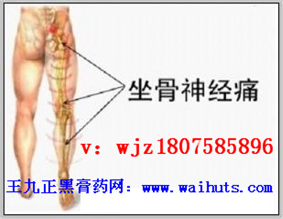 王九正貼 中醫(yī)改善坐骨神經(jīng)痛的真正原理_1