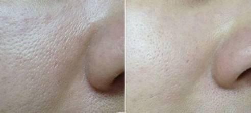 【真人案例】和問題皮膚的持久戰(zhàn)!!!+V.Beauty科技美容的親身體驗（圖）_3