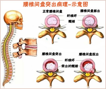 腰間盤突出（部位）壓迫神經(jīng)表現(xiàn)和好的改善方法_1