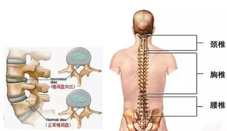 危害那么大，改善腰椎間盤突出最好的方法在這里（圖）_2