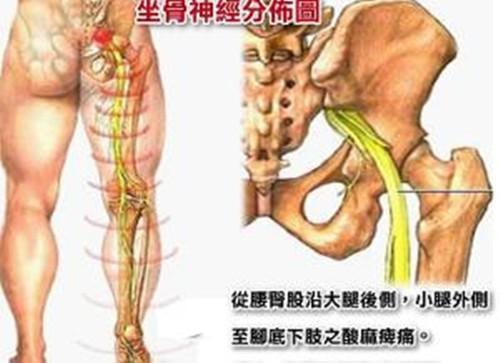 腰椎间盘突出的改善方法有哪些?哪种最管用_2