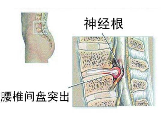 腰突能治愈的徹底嗎？怎么改善好呢？_3