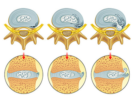 腰椎間盤突出選擇哪種保守改善方法效果最佳（圖）_1