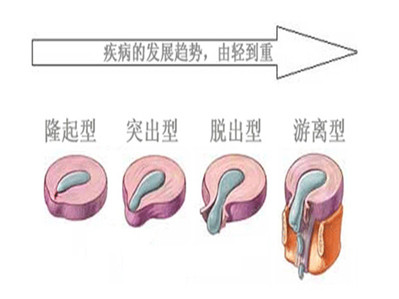 反复发作的腰椎间盘突出怎样治改善果最佳_2