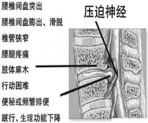 腰椎间盘突出导致腿部酸、痛、麻怎样改善呢？_3