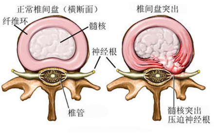 腰椎間盤突出花大錢做改善還不如保守改善_2