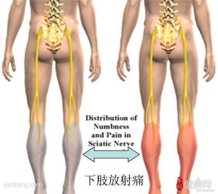 腰椎間盤突出花大錢做改善還不如保守改善_3