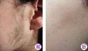 臉部永久脫毛儀器廠家直銷價(jià)格（圖）_3