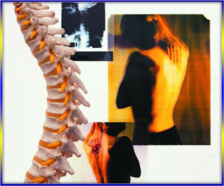 和大家說(shuō)說(shuō)腰椎間盤(pán)突出怎么治改善果最佳？_2