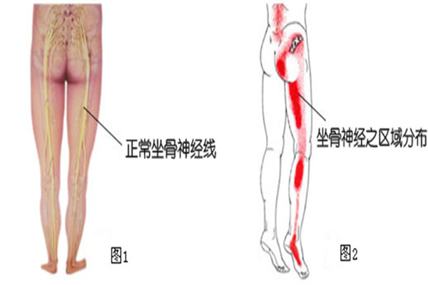 腰突導(dǎo)致坐骨神經(jīng)痛有效保守改善方法在這里（圖）_1