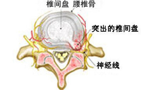 出現(xiàn)腰椎間盤突出，教你有效保守改善_2