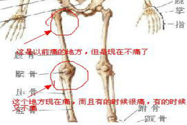 坐骨神经怎会痛？如何改善这一顽疾？（图）_1