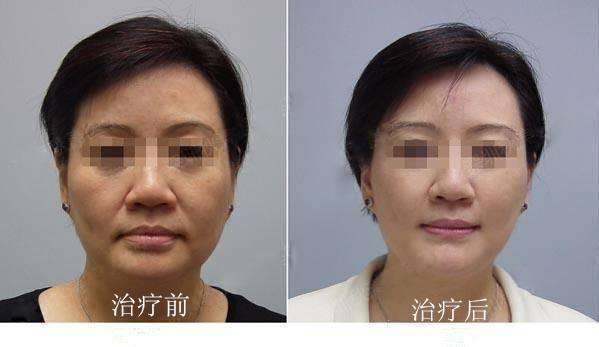 美容院專用面部超聲刀哪種效果好（圖）_1