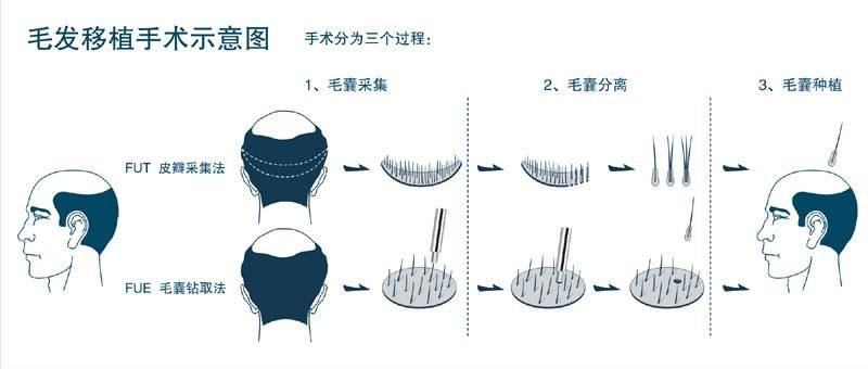 商丘哪有专业植发的地方？（图）_1