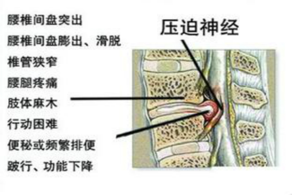 腰突出压迫坐骨神经大腿外侧疼痛，怎么办？（图）_1