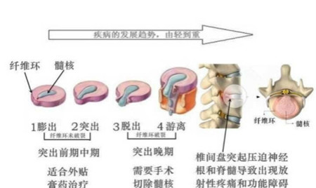 這個方法專治腰椎間盤突出，腰椎不好的都轉(zhuǎn)走（圖）_1