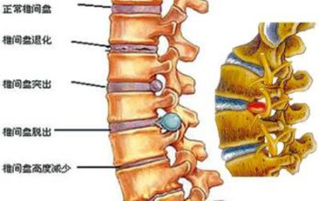 這個方法專治腰椎間盤突出，腰椎不好的都轉(zhuǎn)走（圖）_2