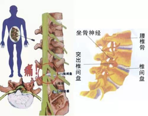 效果非常好改善腰间盘突出的好方法_1