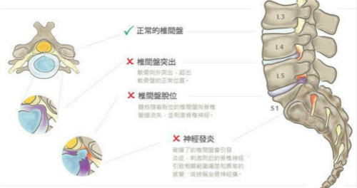 效果非常好改善腰间盘突出的好方法_2