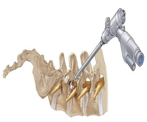 腰椎間盤突出，這樣改善比手術(shù)安全有效多了_2
